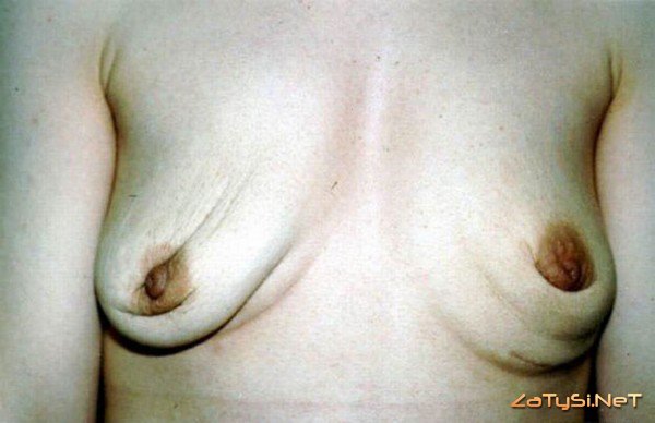 Самая страшная женская грудь (44 фото)